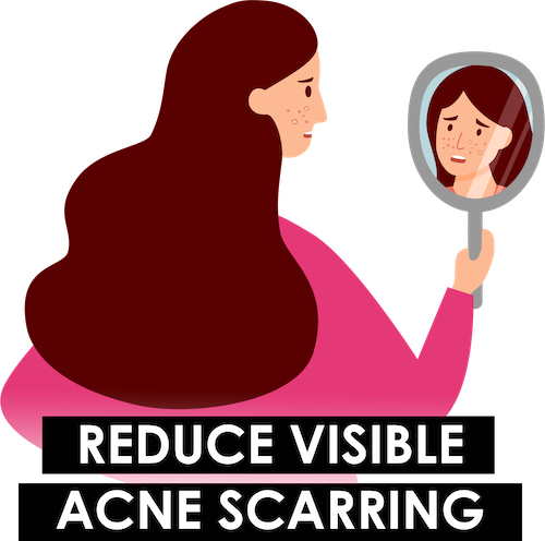 Reduce Acne Scarring
